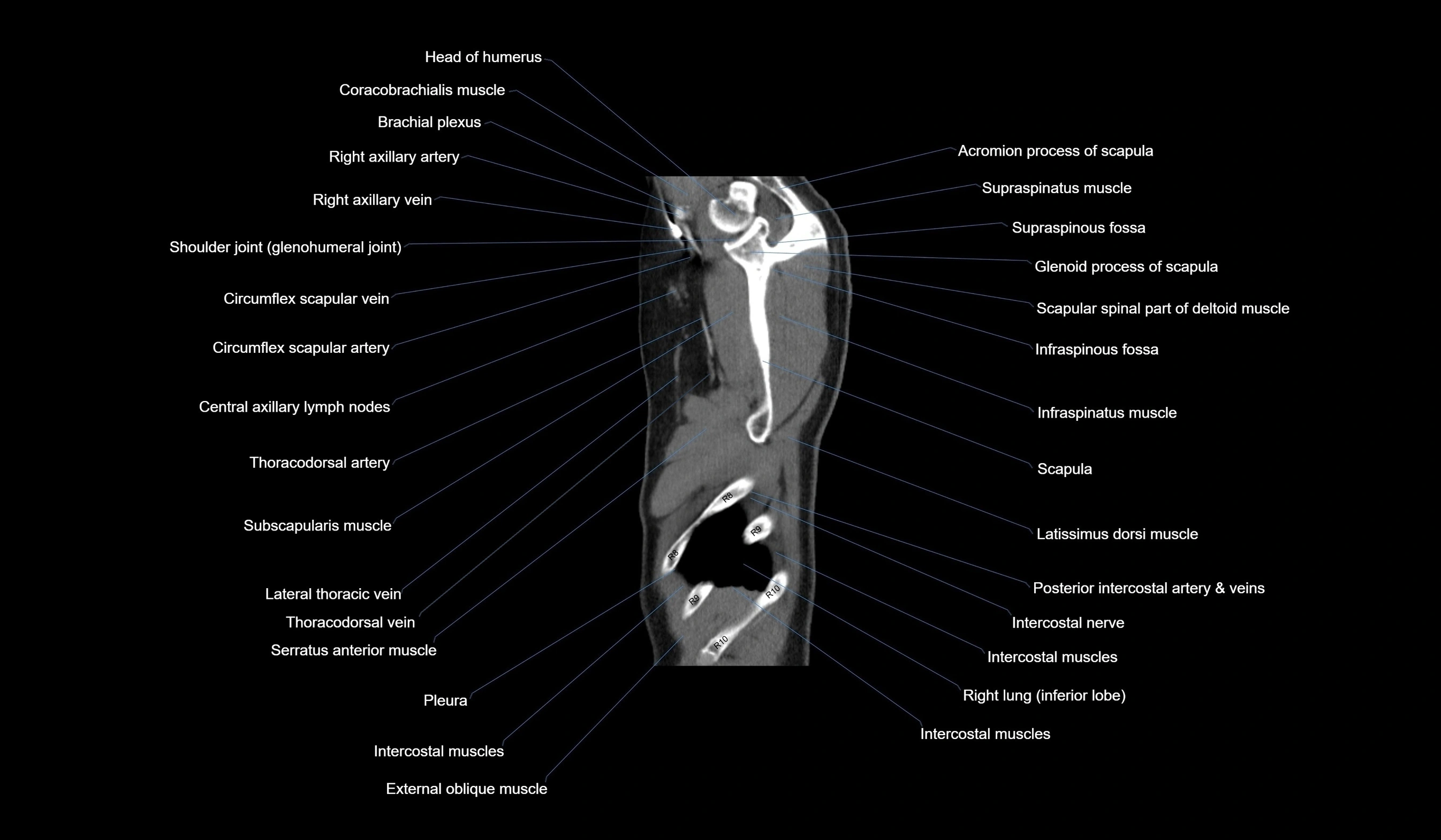 CT chest (thorax) soft tissue window labelled sagittal cross sectional anatomy radiology image-00013.webp